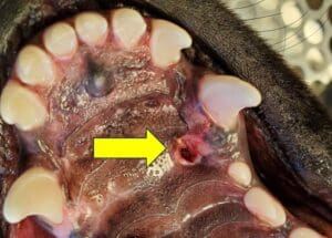 Palatal trauma secondary to a class II malocclusion (overbite). The trauma healed completely after treatment.