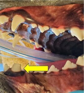 The same patient after crown reduction and vital pulp treatment of the tooth that was contacting the palate