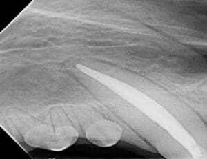 Dental x-ray of a right upper canine after root canal treatment