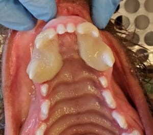 An orthodontic appliance (incline planes) on a patient being treated for linguoverted mandibular canines
