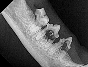 Tooth resorption on the right mandible.