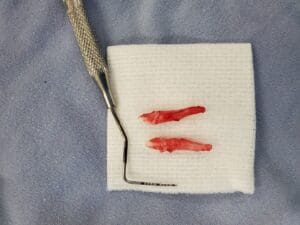 Incisors after extraction